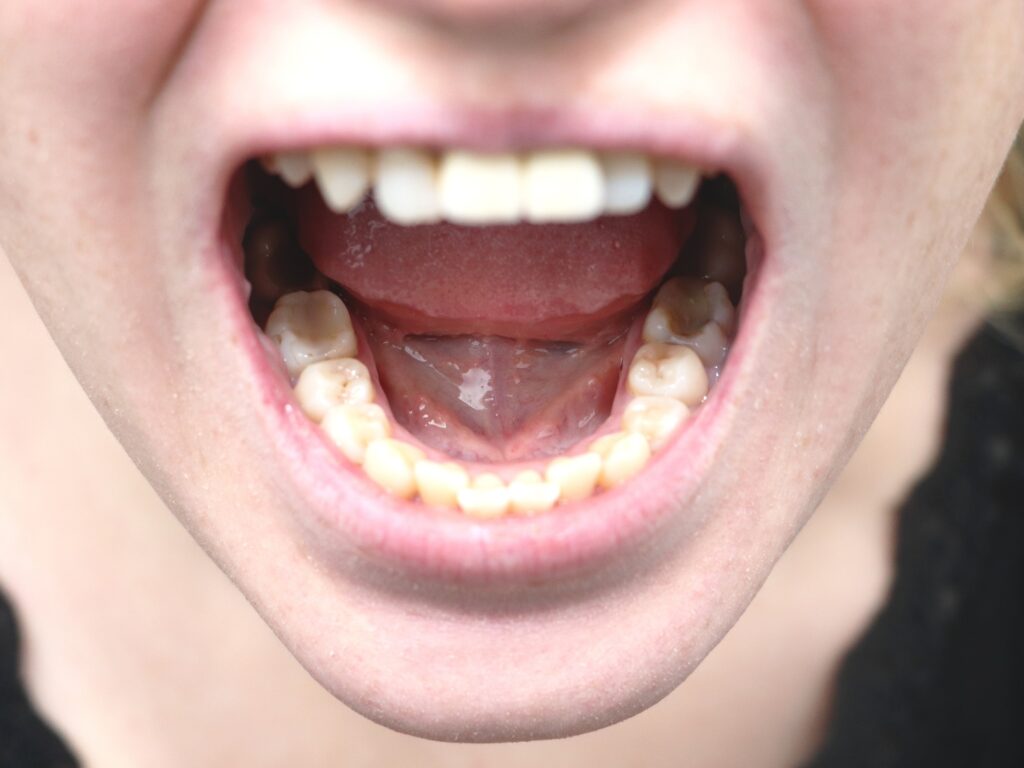 Câncer de boca: sintomas, tratamento e prevenção